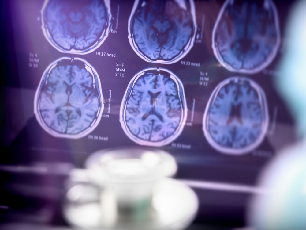 Breakthrough Alzheimer’s drug ‘could slow disease by 8 years’