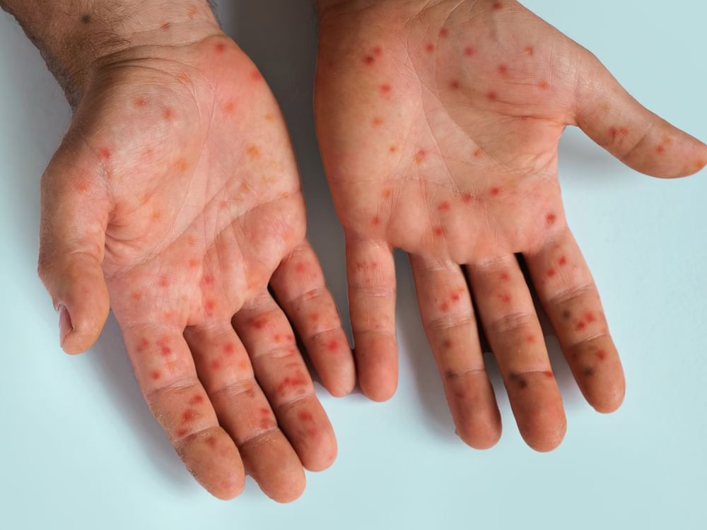الولايات المتحدة تسجل أكثر من 800 إصابة بالحصبة منذ بداية العام